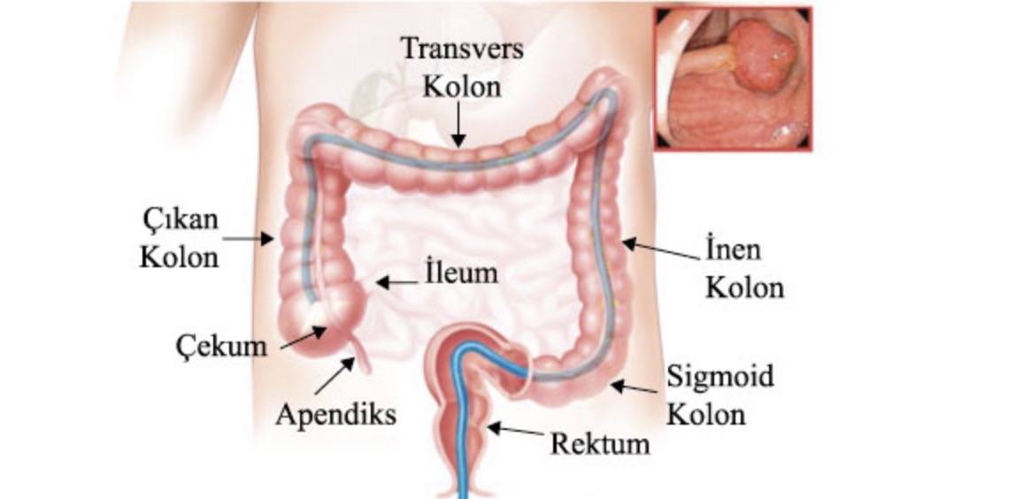 Kalın Bağırsak Kanserinde Poliplerin Önemi